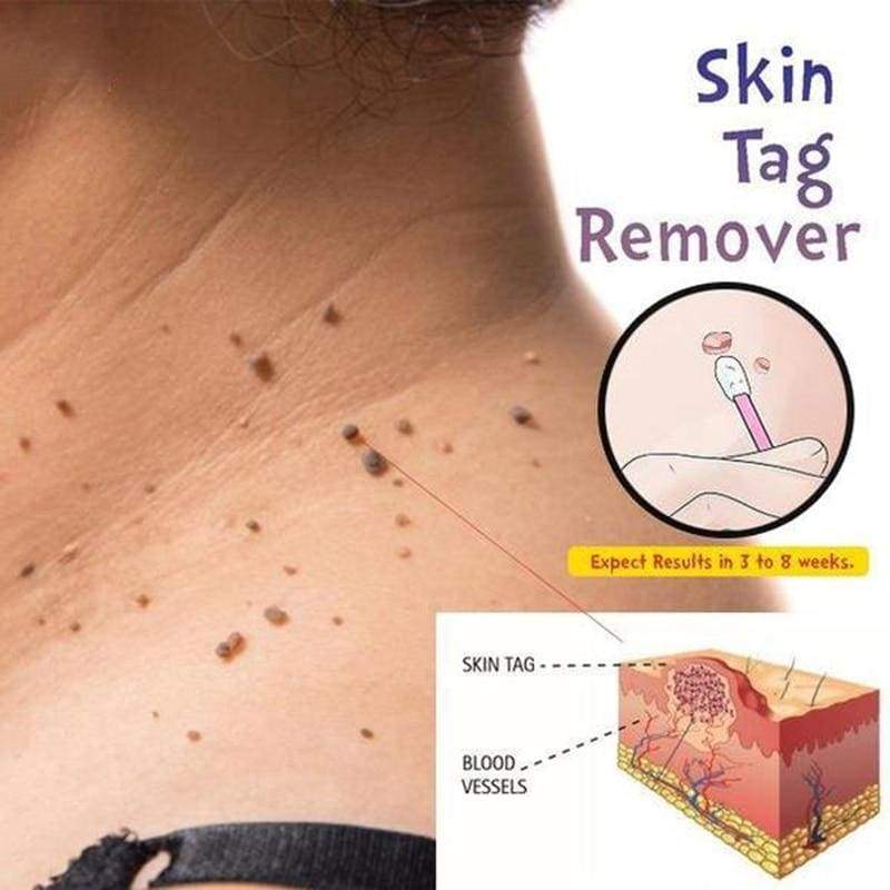 Skin Tag Mole Wart Remover - 200367158